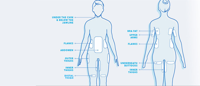 To Whom And For Which Indications Is Cryolipolysis Adapated?