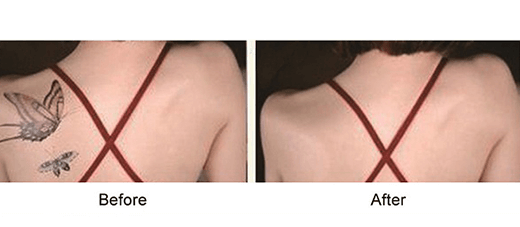 Upper Back Tattoo Removal