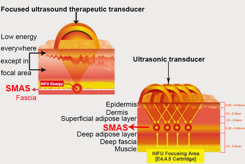 HIFU Skin Tightening