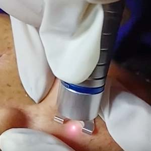 What is new 980nm diode laser for vascular removal?