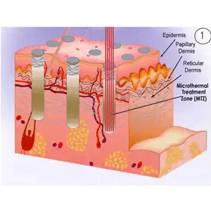 Each hit of the laser produces a Microthermal Treatment Zone smaller than human hair, sparing the intervening normal tissue.