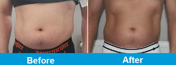 Cryolipolysis Grouponcryotherapy Slimming Machinecryolipolysis