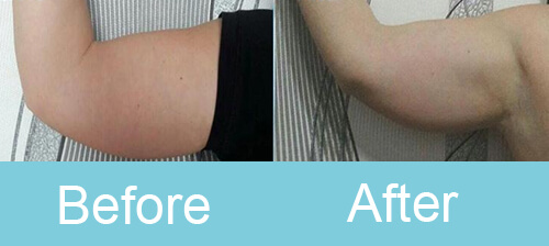 cryolipolysis Arm Treatment