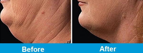 Double Chin Slimming Treatment