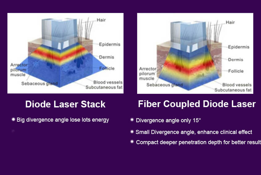 Fiber Coupled Diode Laser Technology