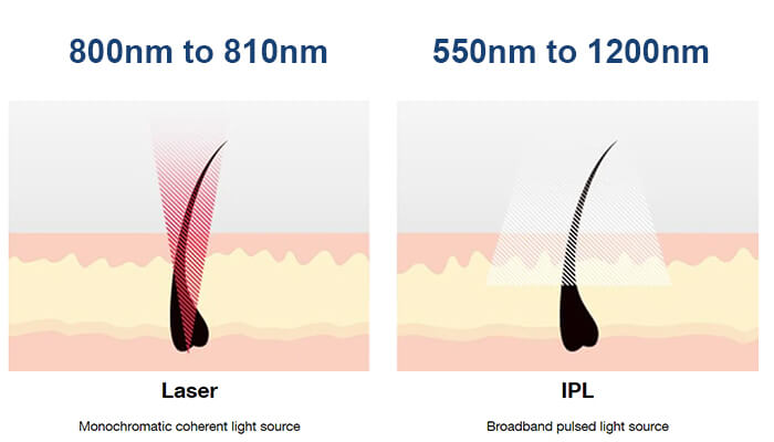 What’s the difference between laser and IPL treatment?