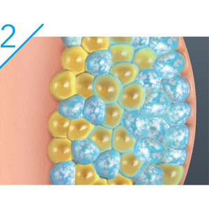 CoolSculpting technology uses controlled cooling to target and kill only these fat cells.