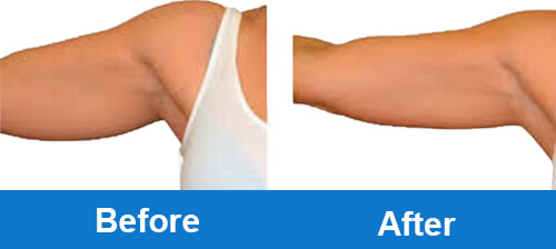 coolsculpting-before-after-photo-for-arm