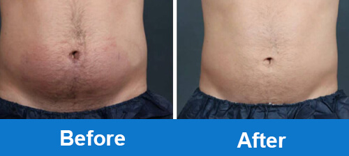 coolsculpting-before-after-photo-for-belly