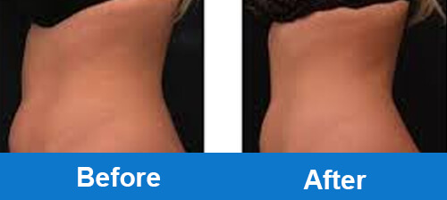 cryo-slimming-treatment-obvious-clinical-resutls-comparison