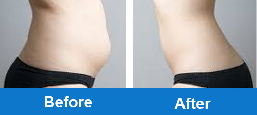 cryolipolysis-slimming-before-after-photo-for-belly