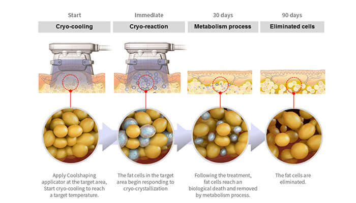 Why choose the zeltiq cryolipolysis machine?