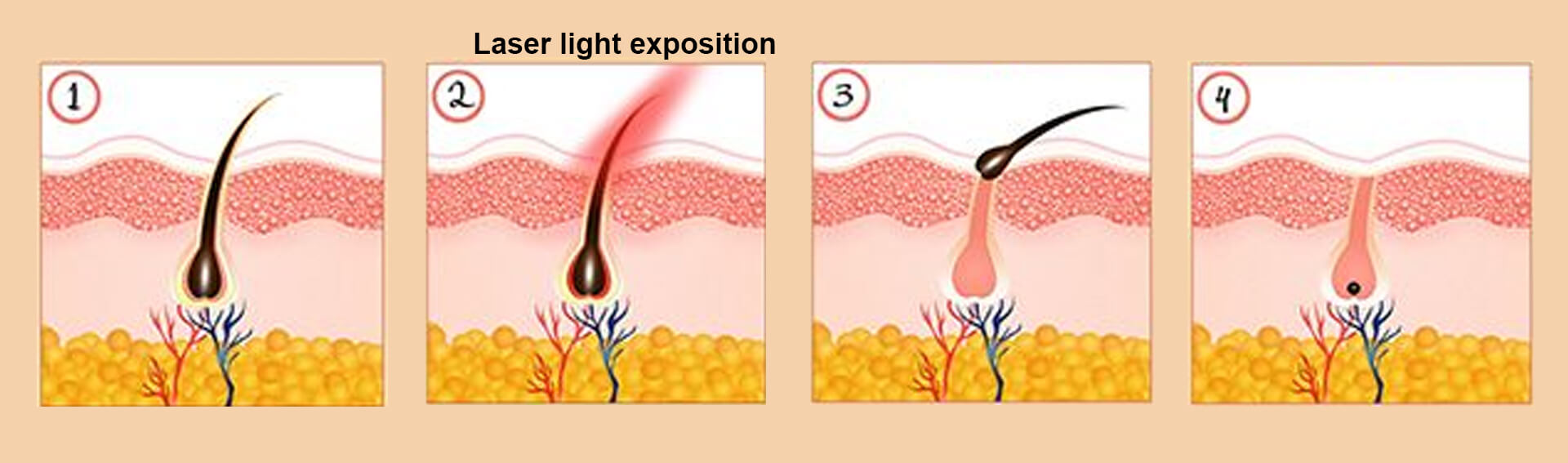 Diode Laser Hair Removal Technology