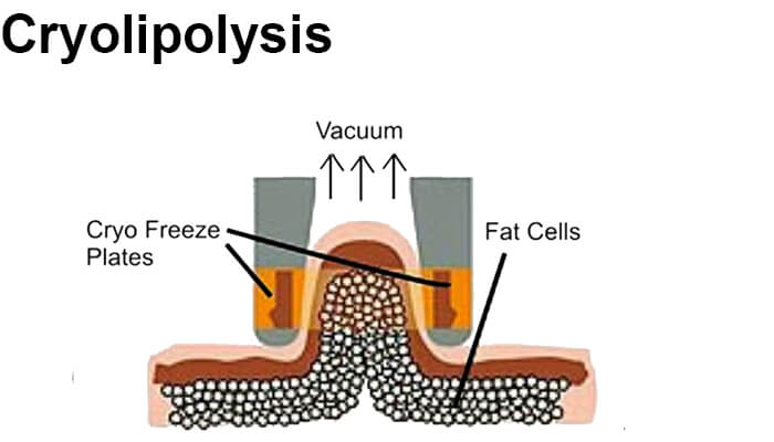 What is cryolipolysis coolsculpting?