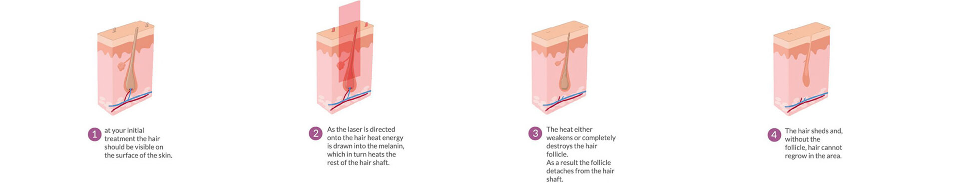 Does diode laser hair removal work?