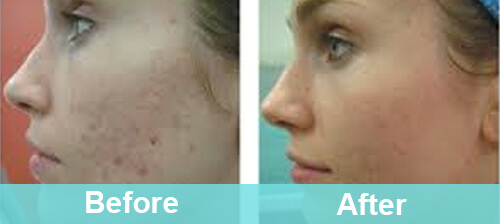 Acne Scar Fractional Laser Treatment