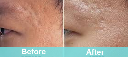 Acne Scar Removal