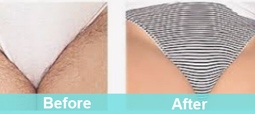 ruimte Spijsverteringsorgaan Elasticiteit Bikini Line Laser Hair Removal - Hair Removal | PrettyLasers