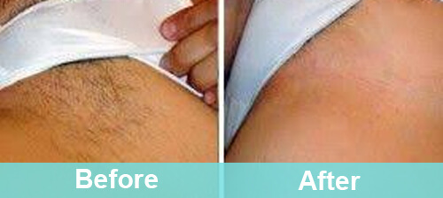 Bikini Line Laser Hair Removal before & after photo