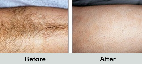 Leg Hair Removal