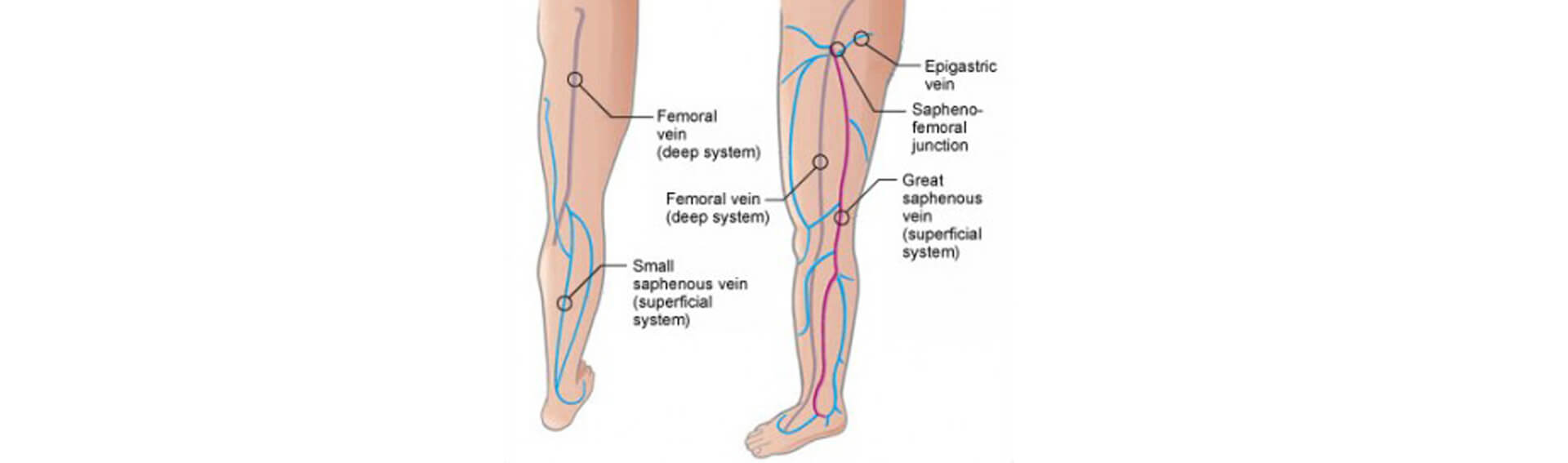 Varicose Veins