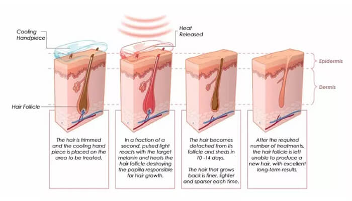 What is SHR Hair Removal Technology?