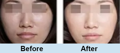 Skin Rejuvenation 