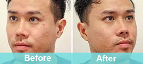 Skin Resurfacing Treatment