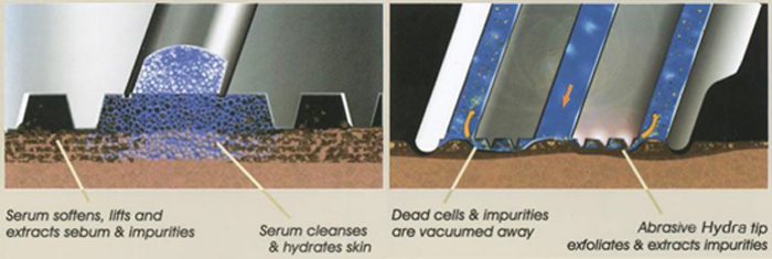 Hydrodermabrasion Technology