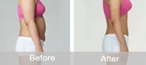 Liposonix Body Shaping