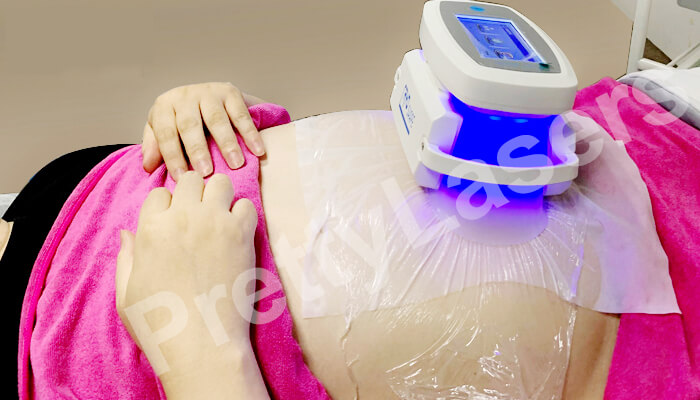 Coolsculpting Machine Applications