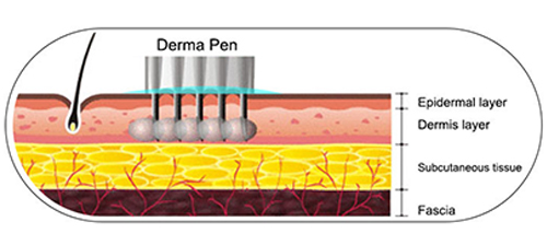 Derma Pen