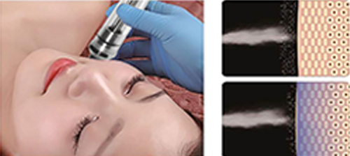 Diamond peel