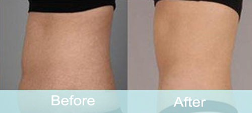 belly fat removal