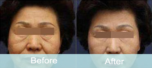 hifu face lift before and after