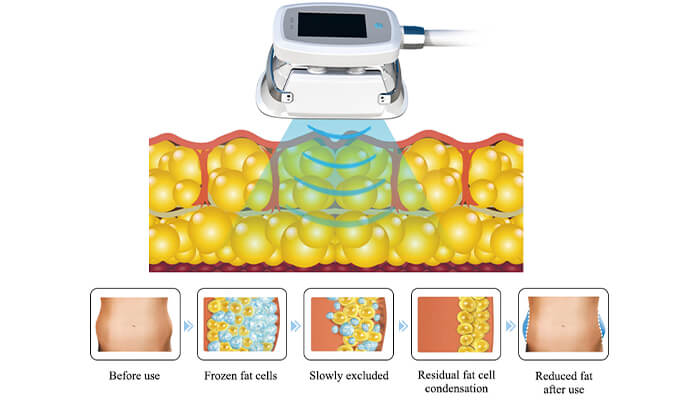 How does a cool sculpting machine work?