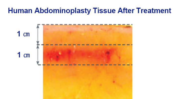 Human Abdominoplasty Tissue After Treatment