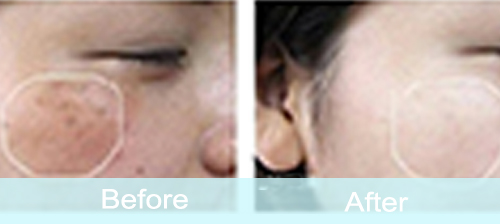 hydrafacial-machine-treatment-before-after-pictures