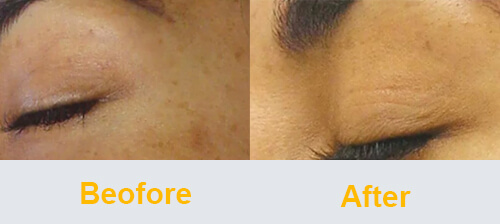 Hyperpigmentation