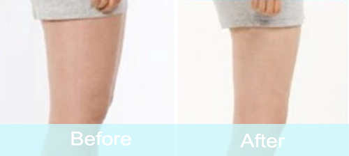 Leg Cellulite Removal