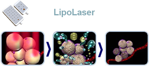 LipoLaser principle LipoLaser principle