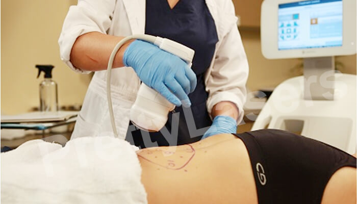 Liposonix Treatment Liposonix Treatment
