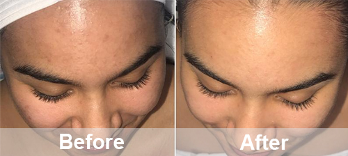 remove age spots and dark pigmentation