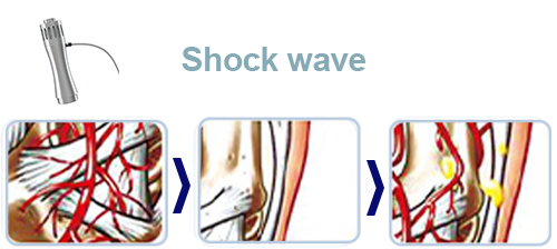 Shock wave principle