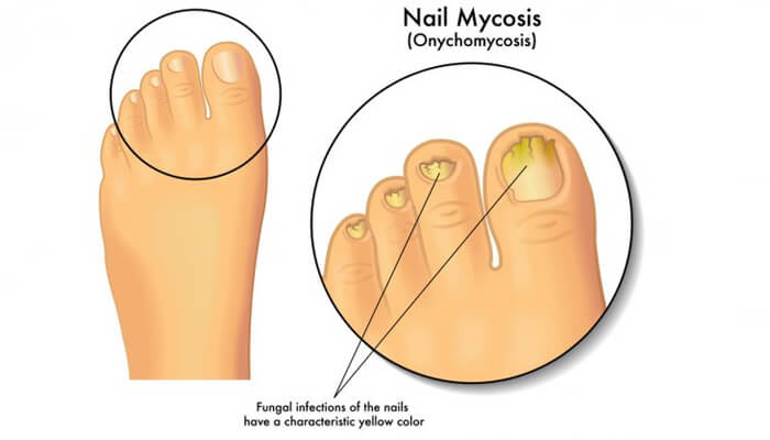 Onychomycosis