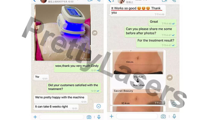 coolsculpting machine customer feedback