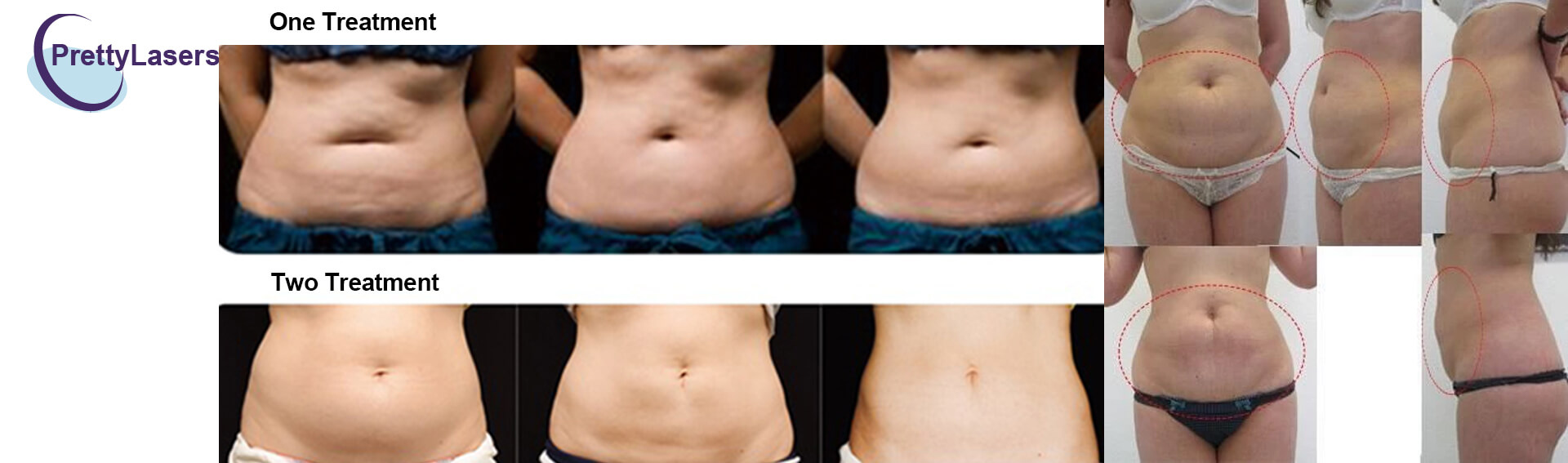 Cryolipolysis Contrast