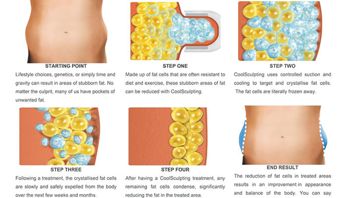 Cryolipolysis Machine Working Principle