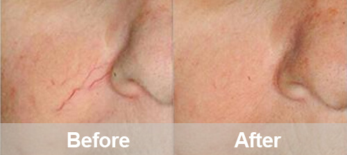 Facial Spider Veins Removal