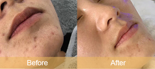 Diminish acne scars 